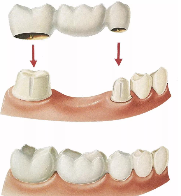 固定牙桥